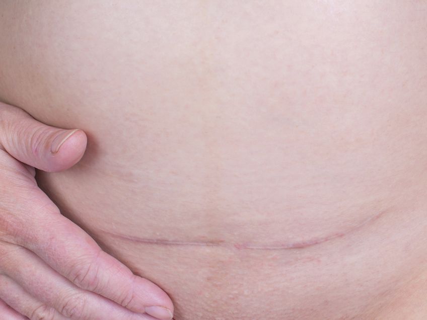 Do This To Your C-Section Scar EVERY DAY To Flatten/Prevent C