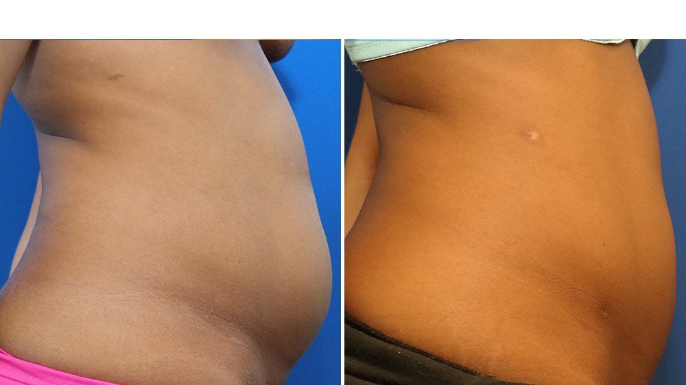 A Closer Look at Liposuction for Abdominal Fat Removal