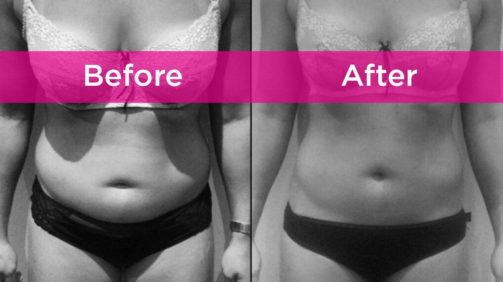 Should You Try CoolSculpting to Lose Weight?