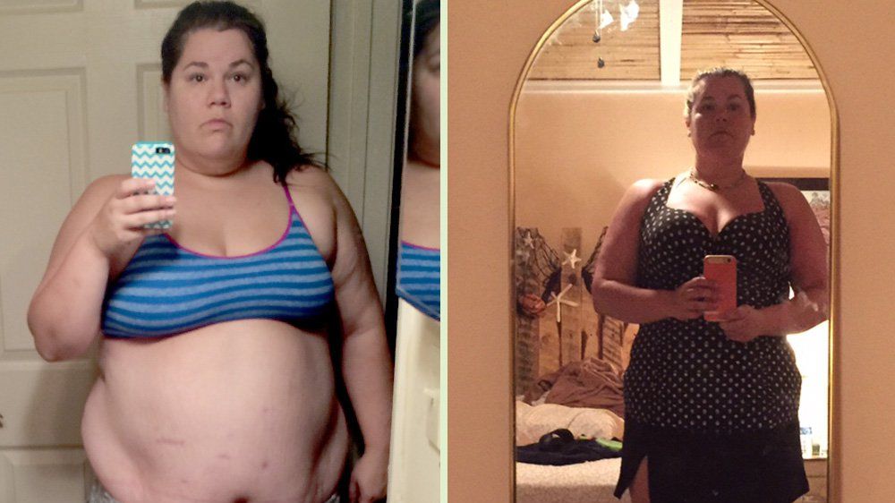 9 Things I Wish I Knew About Gastric Bypass Surgery Before I Had