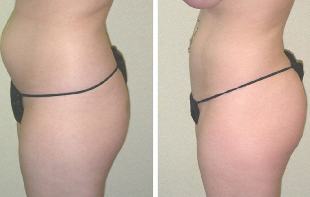 butt lift fat transfer before and after