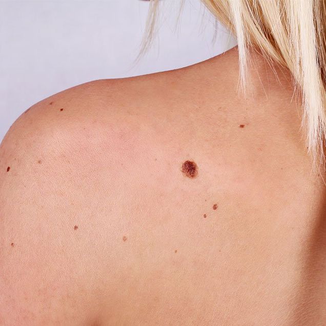 skin cancer causes surprising