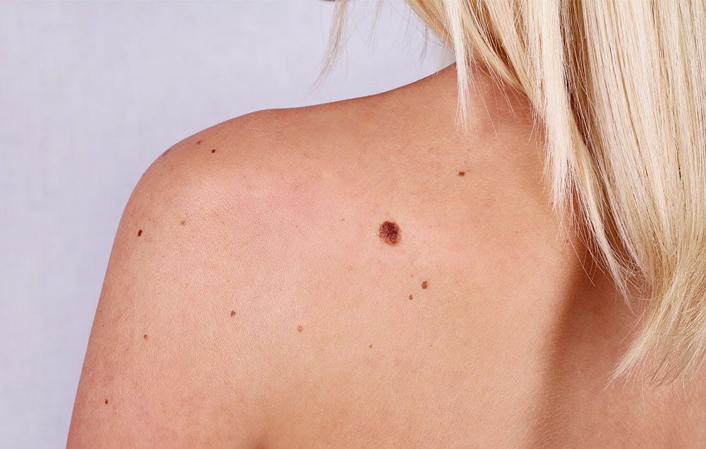 skin-cancer-surprising-causes-women-s-health