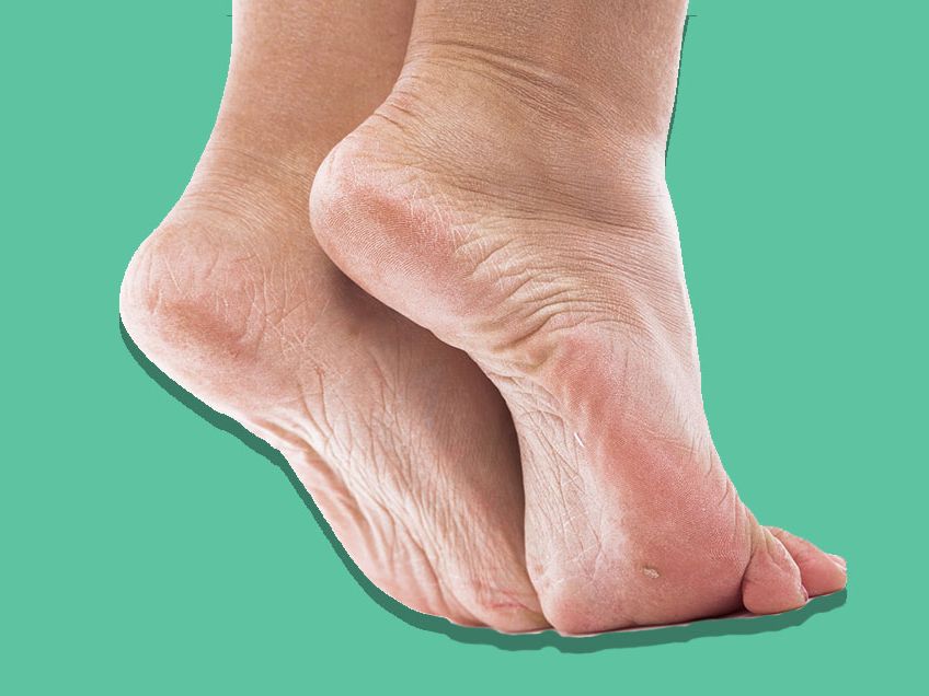 Satisfying hard skin on foot callus removal 