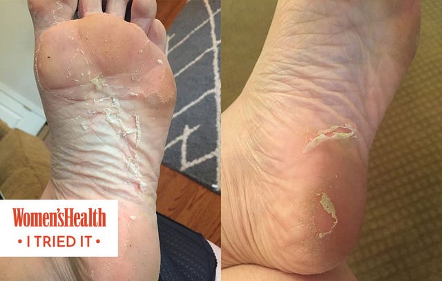 Baby Foot Peel I Tried It And Here S What Happened Women S Health