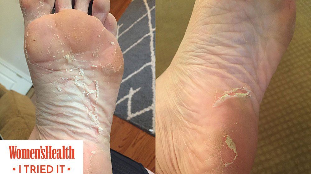 How to Remove Dead Skin from Feet: 7 Methods to Try