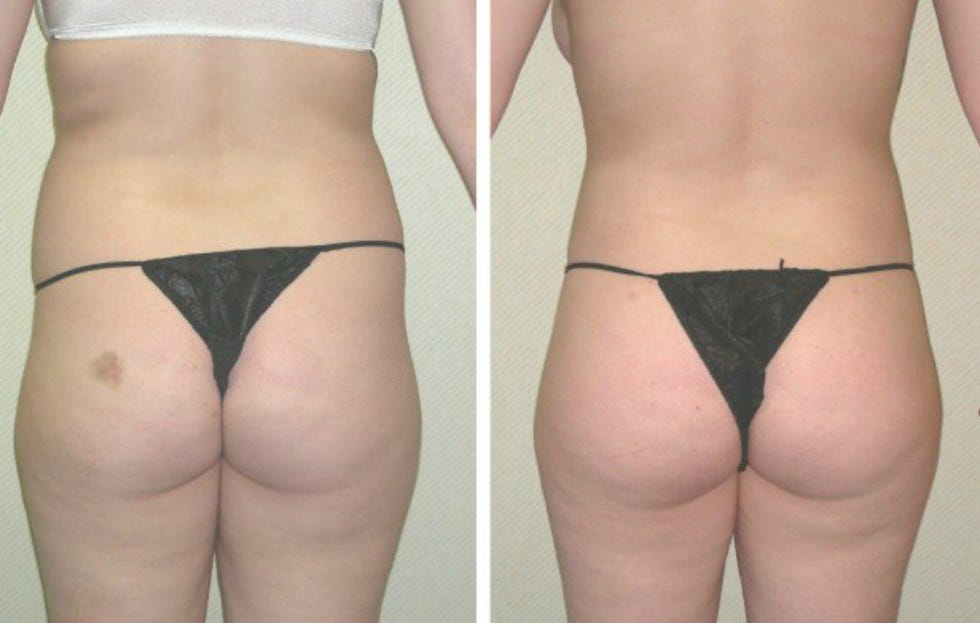 fat transfer butt lift brazilian butt lift