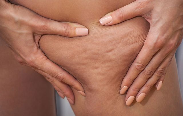 What You Need To Know About The Connection Between Cellulite And Weight Loss