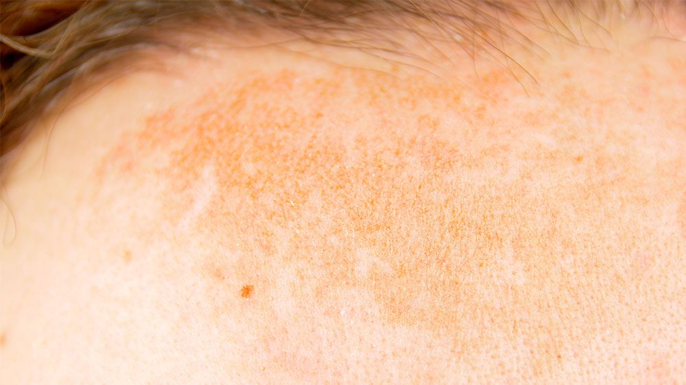 7 Ingredients Dermatologists Use to Treat Dark Spots – SLMD Skincare by  Sandra Lee, M.D. - Dr. Pimple Popper