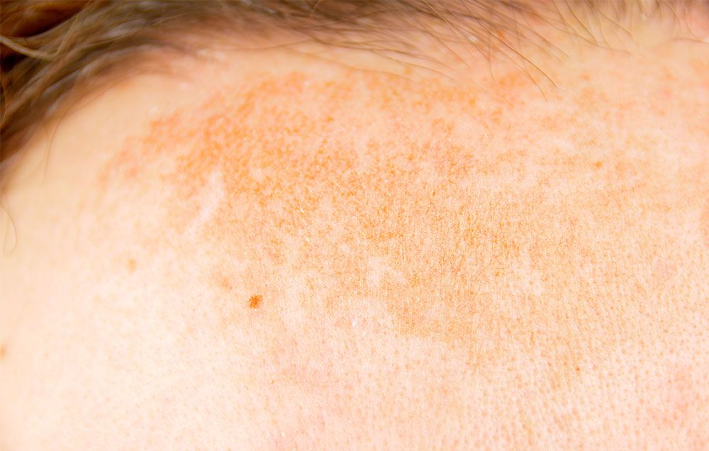 Dr. Pimple Popper dark spot treatment