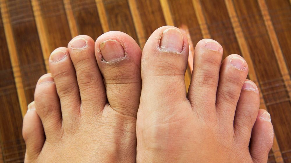 CAUSE OF AND CURE FOR THICK TOENAILS - FULL EXPLANATION & TREATMENT 