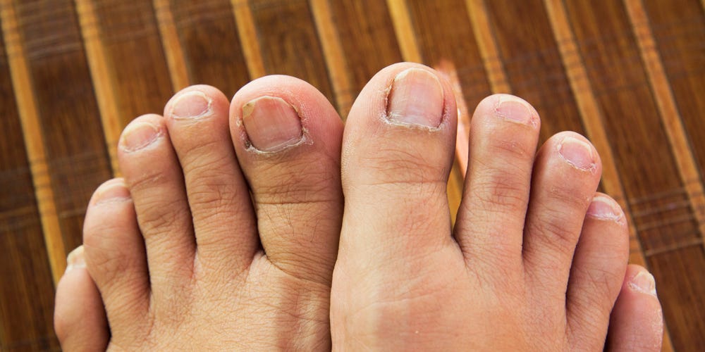 Weird Things That Can Happen To Your Toenails And Feet | Women's Health