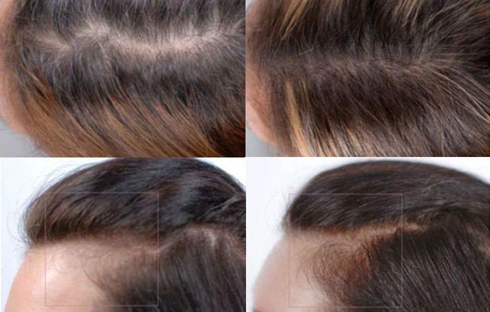 NATURELO Hair, Skin and Nails Vitamins - 5000 mcg Biotin, Collagen, Natural  Vitamin E - Supplement for Healthy Skin, Hair Growth for Women and Men – 60  Capsules - Walmart.com