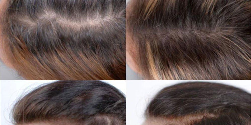 Nutrafol For Hair Loss - Does Nutrafol Work? | Women's Health