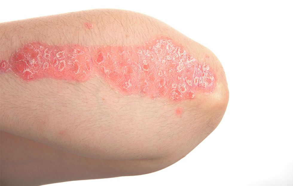 psoriasis plaques on arm