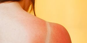 Why you keep getting sunburnt
