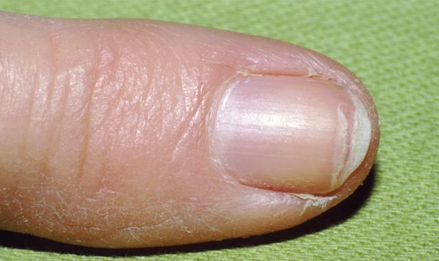 What Causes Fingernails to Split Down the Middle: A Comprehensive  Examination of the Causes - PharmEasy Blog