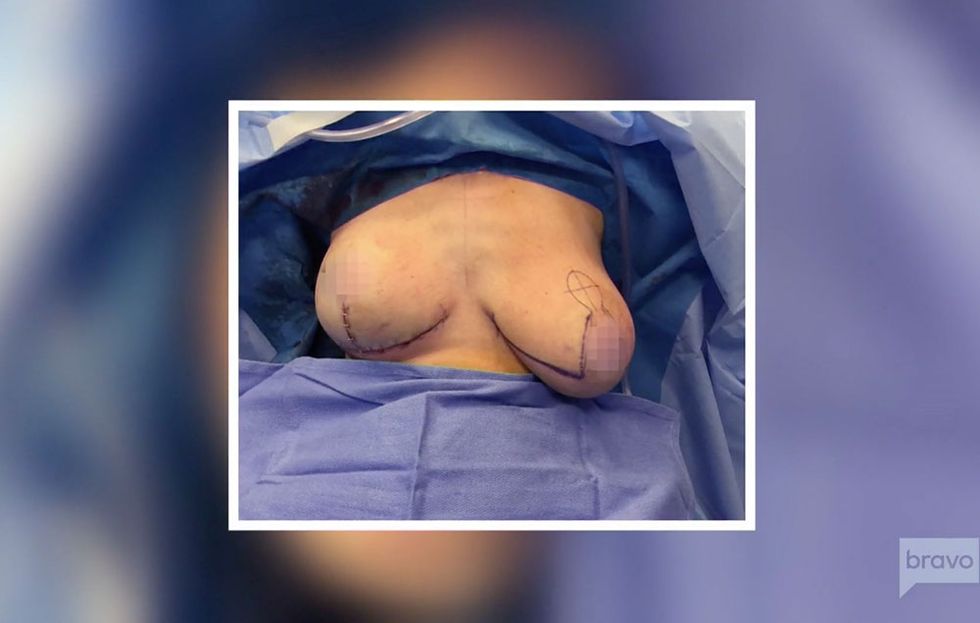 Stassi Schroder breast reduction surgery photo