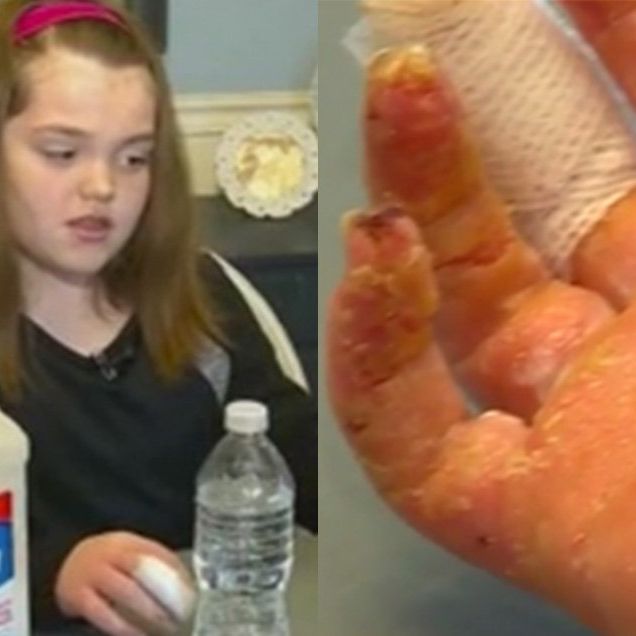 Girl Gets Third-Degree Burns From Homemade Slime
