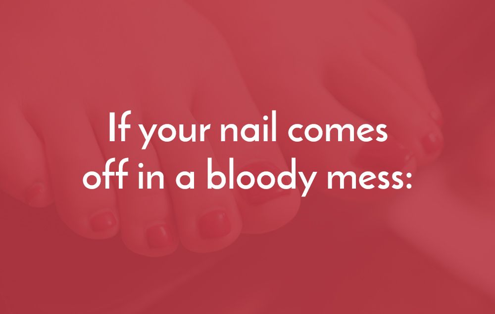 Exactly What To Do If Your Toenail Falls Off | Women's Health