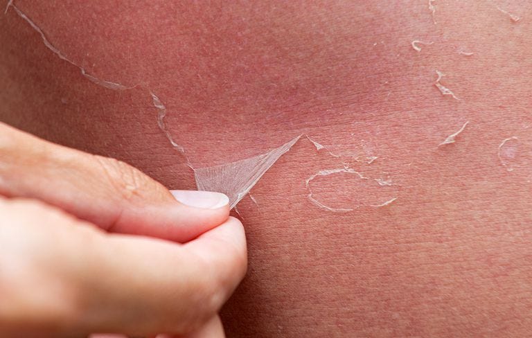 peeling skin