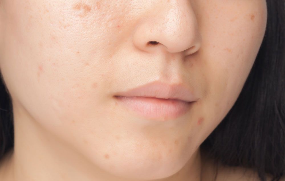 9 Amazing Rosehip Oil Skin Benefits - What Is Rosehip Seed Oil Good For? 9 Amazing Rosehip Oil Skin Benefits - What Is Rosehip Seed Oil Good For?