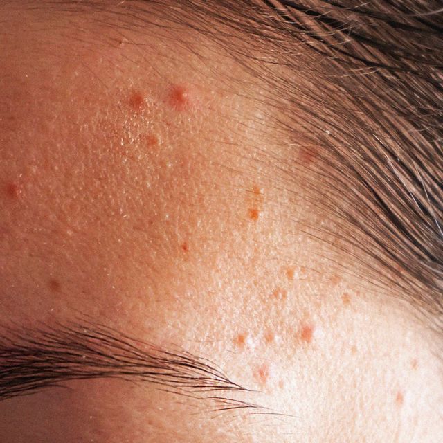 Facts, causes, solutions: all you need to know about acne in under 3  minutes, Skin Secrets