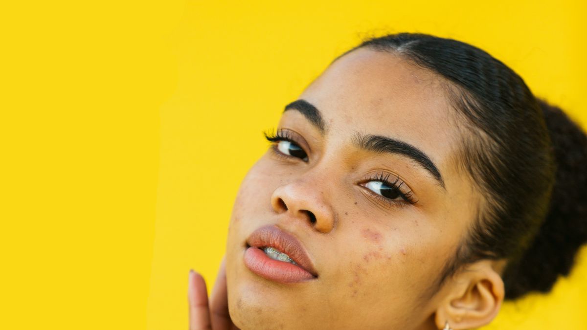 preview for Diez ‘celebrities’ que han tenido acné adulto