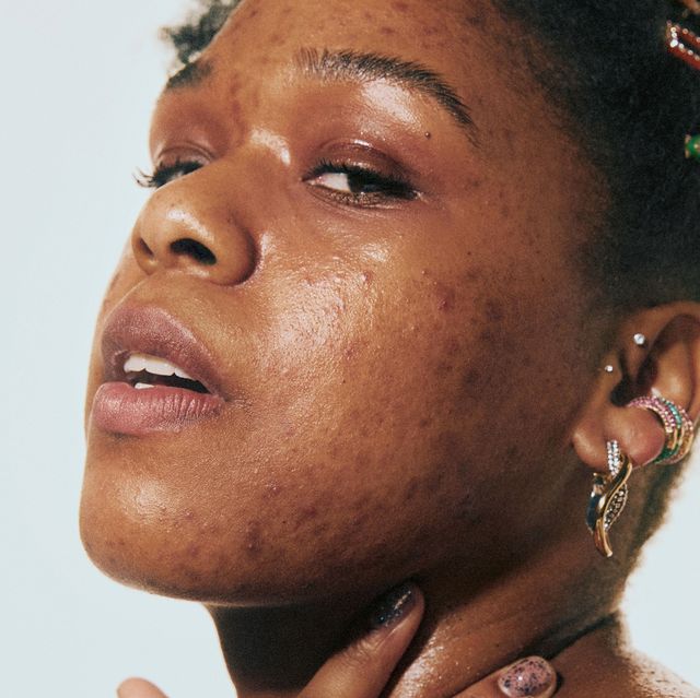 Acne spots: what are they?