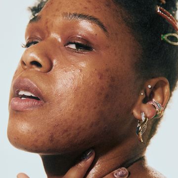 best acne spot treatments