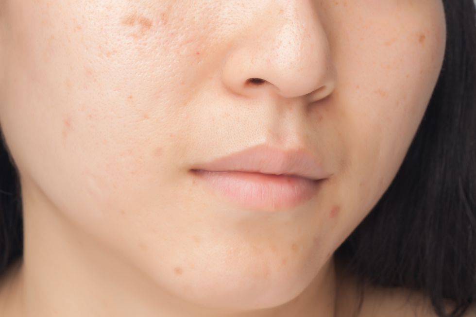 Acne spots