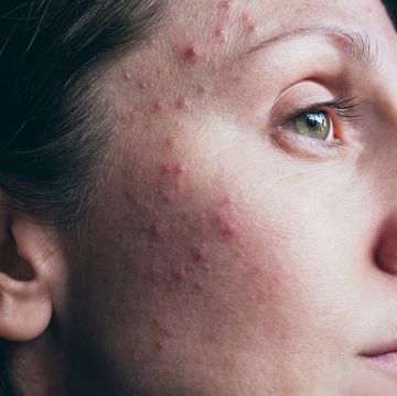 acne woman skin closeup with hormonal acne pimples before photo
