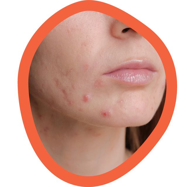 How To Er Up Every Type Of Acne