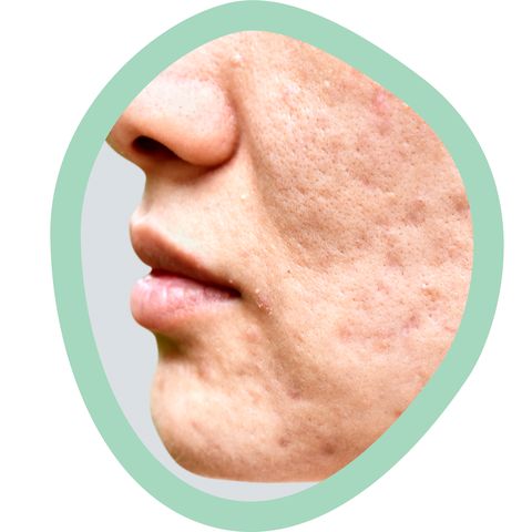 textured scars from acne