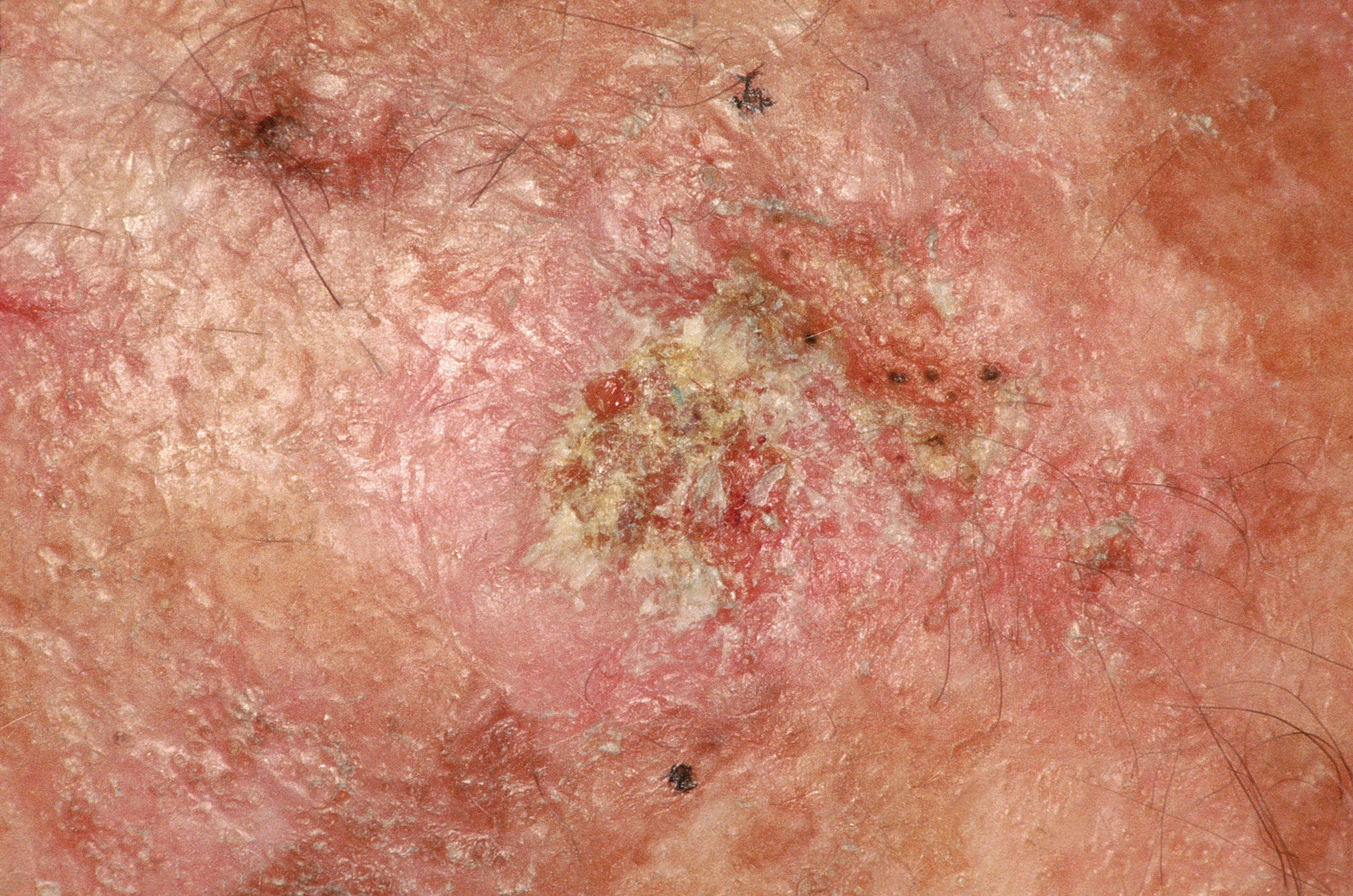 Actinic Keratosis skin cancer