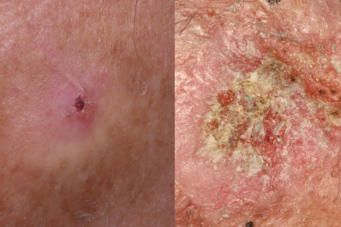 actinic keratosis skin cancer pictures