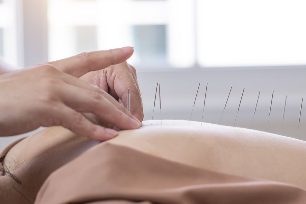 acupuncture woman, spa ,back spa