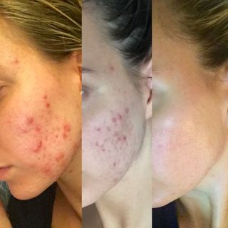 Adeline Waugh acne transformation
