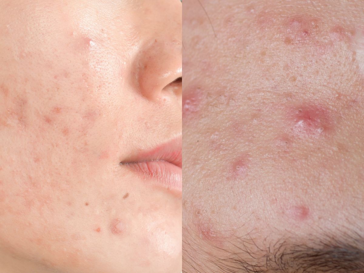 6 Adult Acne Causes and How to Get Rid of It, Say Dermatologists