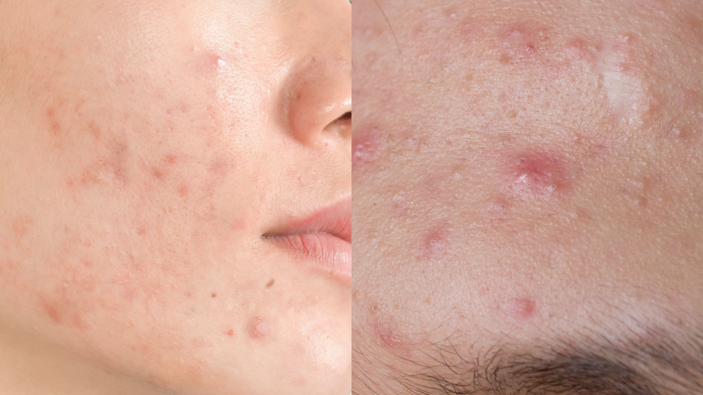 Acne Pustules on Face: How to Get Rid of Pustules?