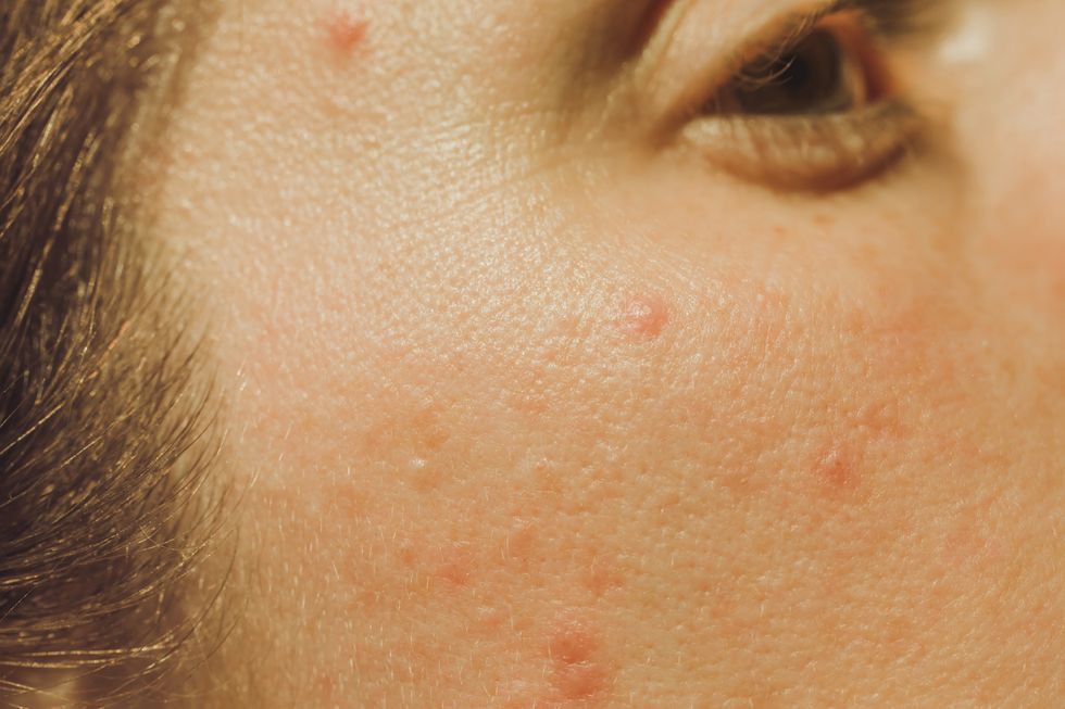 adult acne skin closeup with pimples, blemishes