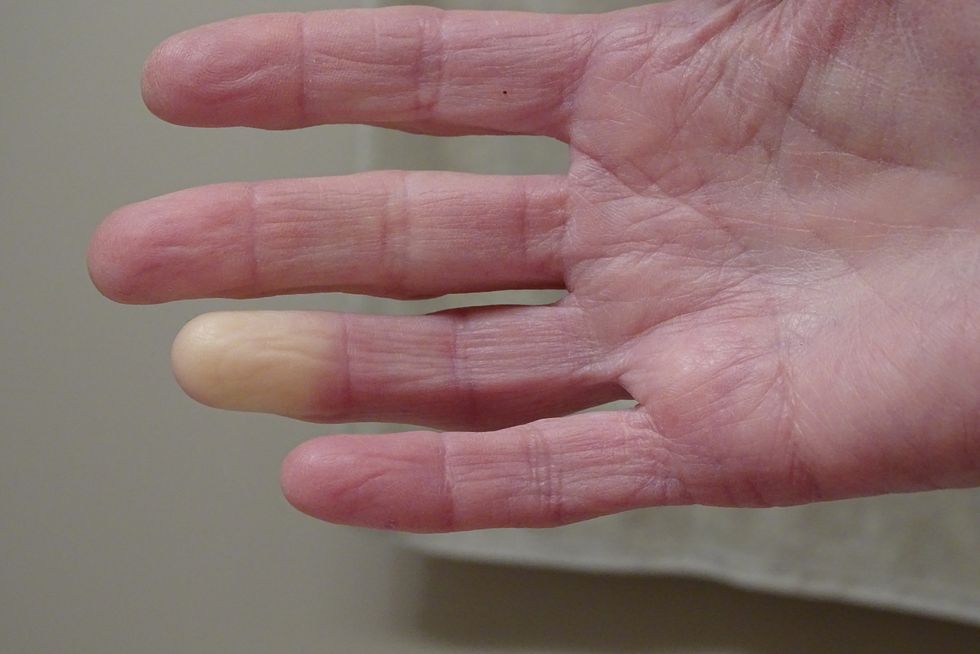 adult hand with raynaud syndrome phenomenon