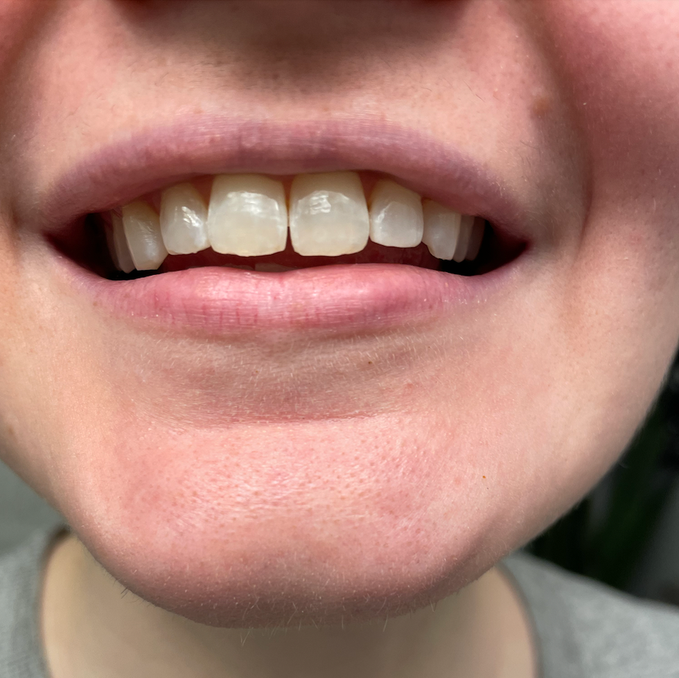 snow teeth whitening kit testing, a photo of the tester's teeth after testing