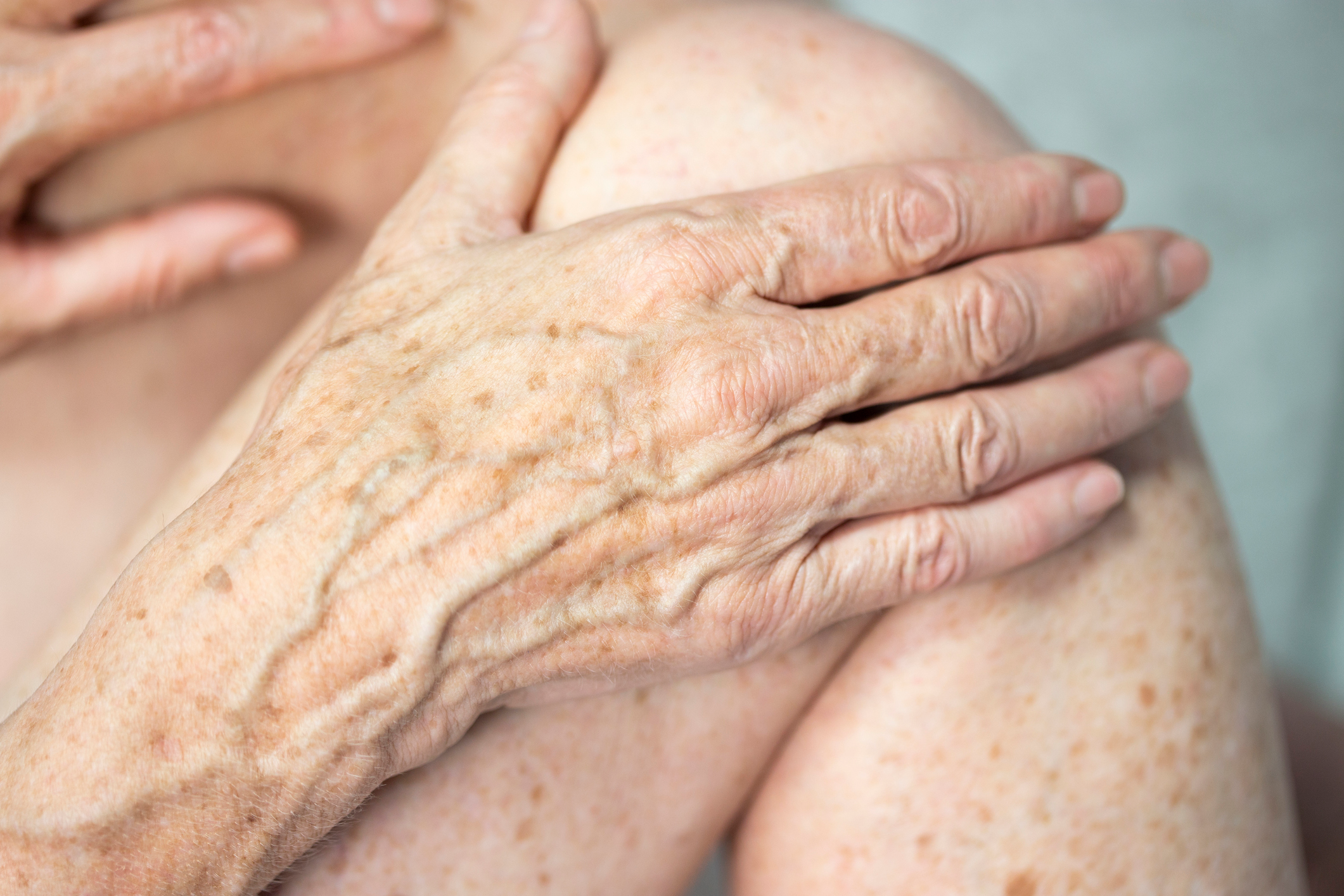 6 Ways To Get Rid Of Age Spots On Your Hands Say Dermatologists