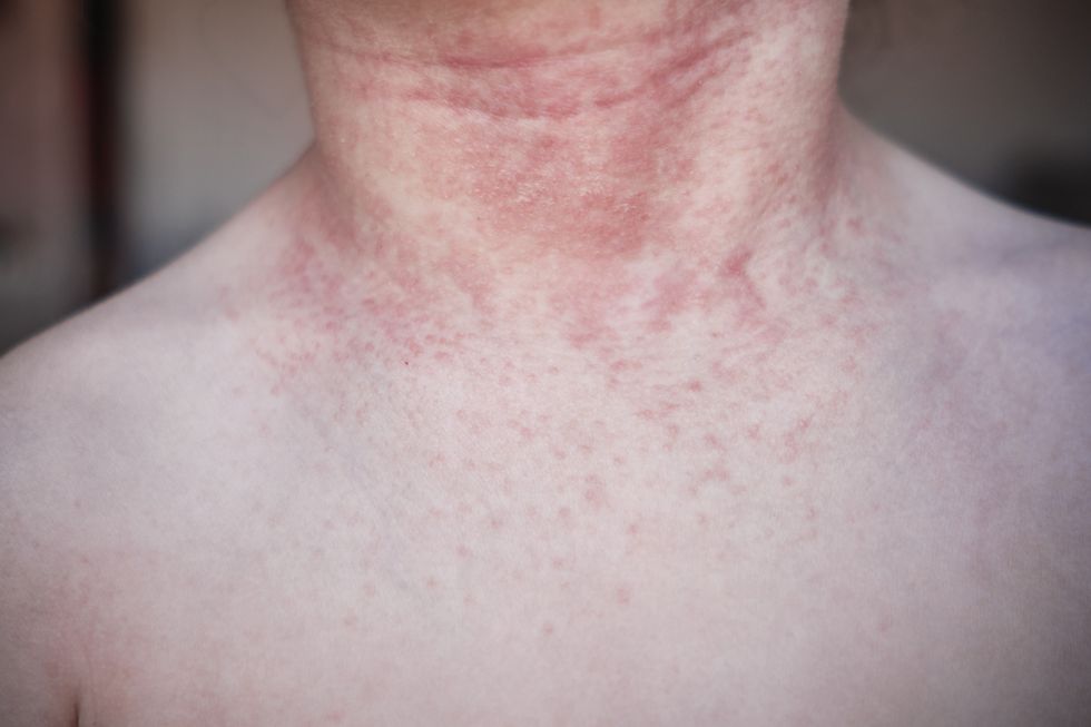 allergic reaction due to contact with animals on human skin