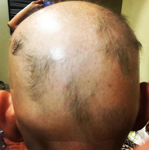 Alopecia kristy devaney