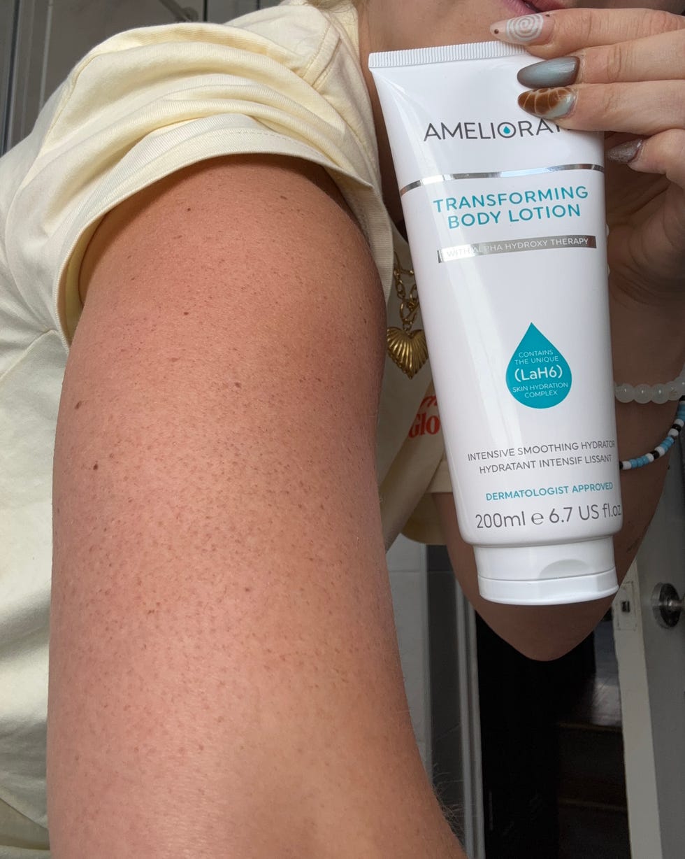 keratosis pilaris treatment