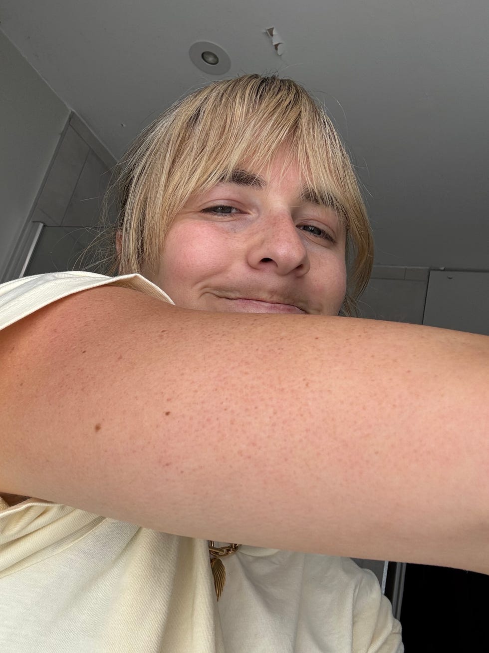keratosis pilaris treatment