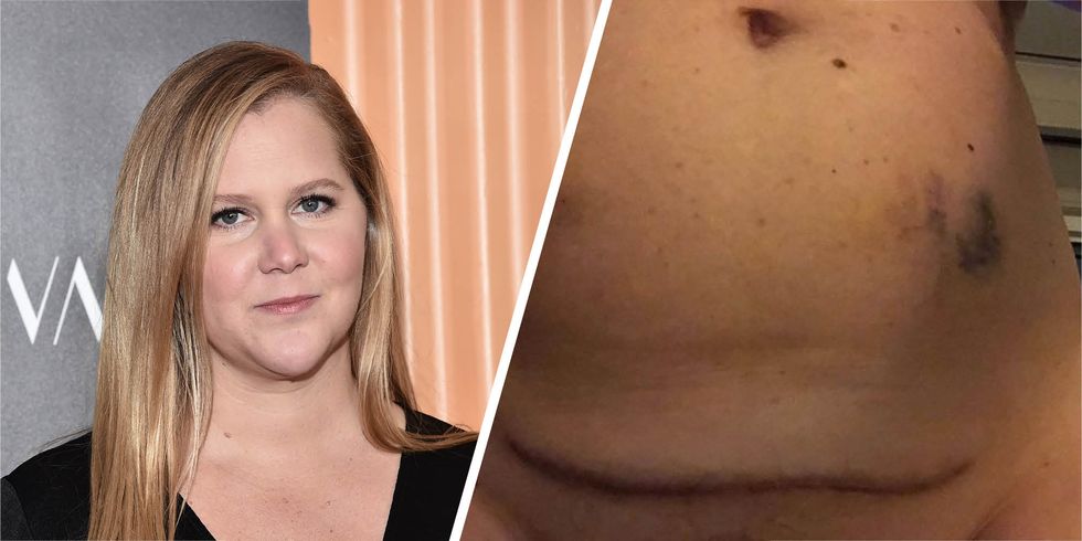 Amy Schumer, c-section, scar