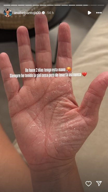 anabel pantoja comparte una imagen de su mano con problemas de sequedad